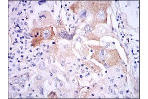 Immunohistochemical analysis of paraffin-embedded lung cancer tissues using IL1B mouse mAb with DAB staining. (IL-1 beta anticorps)