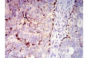 Immunohistochemical analysis of paraffin-embedded cervical cancer tissues using CD182 mouse mAb with DAB staining. (CXCR2 anticorps)