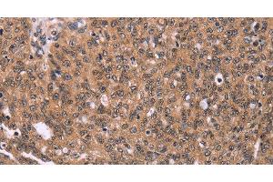 Immunohistochemistry of paraffin-embedded Human ovarian cancer using ERAS Polyclonal Antibody at dilution of 1:40
