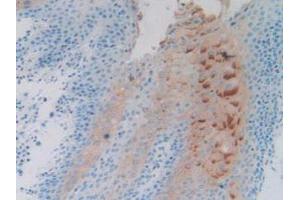 IHC-P analysis of Human Stomach Cancer Tissue, with DAB staining. (PTPRH anticorps  (AA 844-1096))