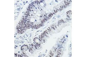 Immunohistochemistry of paraffin-embedded human colon carcinoma using NCOR1 Rabbit pAb (ABIN6130574, ABIN6144420, ABIN6144421 and ABIN6222831) at dilution of 1:100 (40x lens).