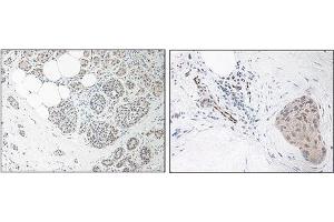Formalin-Fixed, Paraffin-Embedded Sections of human breast malignant ductal adenocarcinoma stained with Interleukin-33 antibody