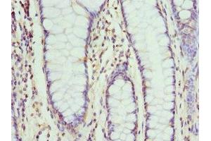 Immunohistochemistry of paraffin-embedded human colon cancer using ABIN7161336 at dilution of 1:100