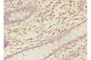 Immunohistochemistry of paraffin-embedded human colon cancer using ABIN7161139 at dilution of 1:100 (COBRA1 anticorps  (AA 8-199))