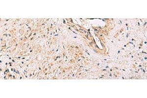 Immunohistochemistry of paraffin-embedded Human prost ate cancer tissue using PCYT2 Polyclonal Antibody at dilution of 1:55(x200) (PCYT2 anticorps)