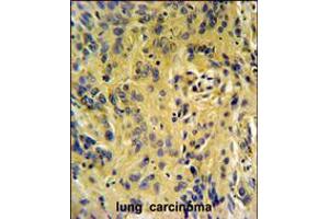 TESC Antibody IHC analysis in formalin fixed and paraffin embedded human lung carcinoma followed by peroxidase conjugation of the secondary antibody and DAB staining.