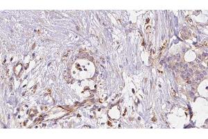 ABIN6273043 at 1/100 staining Human liver cancer tissue by IHC-P. (ERO1LB anticorps  (Internal Region))