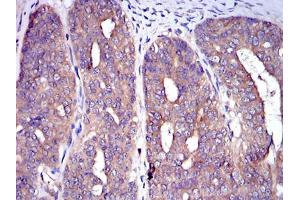 Immunohistochemical analysis of paraffin-embedded ovarian cancer tissues using C-CBL mouse mAb with DAB staining. (CBL anticorps)