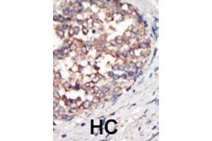 Formalin-fixed and paraffin-embedded human cancer tissue reacted with the primary antibody, which was peroxidase-conjugated to the secondary antibody, followed by AEC staining. (PIK3 gamma anticorps  (C-Term))