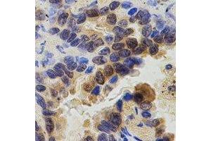 Immunohistochemical analysis of ZAP70 staining in human lung cancer formalin fixed paraffin embedded tissue section.