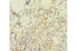 Immunohistochemistry of paraffin-embedded human pancreatic cancer using ABIN7164521 at dilution of 1:100 (SMARCA2 anticorps  (AA 700-1216))