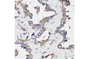 Immunohistochemistry of paraffin-embedded human lung cancer using Cyclin B1 antibody (ABIN7266555) at dilution of 1:100 (40x lens).
