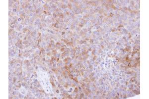 IHC-P Image Immunohistochemical analysis of paraffin-embedded H1299 xenograft , using CKAP1, antibody at 1:500 dilution. (TBCB anticorps)