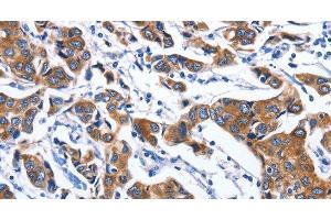 Immunohistochemistry of paraffin-embedded Human breast cancer tissue using MYH1 Polyclonal Antibody at dilution 1:40 (MYH1 anticorps)