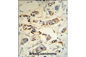 C1QA Antibody (C-term) (R) IHC analysis in formalin fixed and paraffin embedded human breast carcinoma tissue followed by peroxidase conjugation of the secondary antibody and DAB staining. (C1QA anticorps  (C-Term))