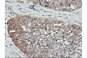 Immunohistochemical staining of paraffin-embedded Adenocarcinoma of Human ovary tissue using anti-ASCC1 mouse monoclonal antibody. (ASCC1 anticorps)