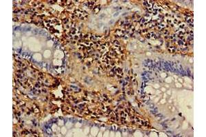 Immunohistochemistry of paraffin-embedded human colon cancer using ABIN7161494 at dilution of 1:100