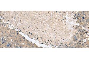 Immunohistochemistry of paraffin-embedded Human liver cancer tissue using KCTD7 Polyclonal Antibody at dilution of 1:55(x200) (KCTD7 anticorps)