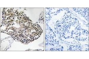Immunohistochemistry analysis of paraffin-embedded human breast carcinoma tissue, using RPS25 Antibody.