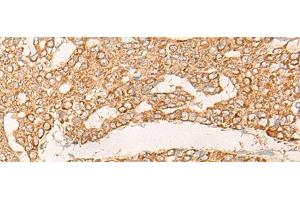 Immunohistochemistry of paraffin-embedded Human liver cancer tissue using KRT9 Polyclonal Antibody at dilution of 1:30(x200)