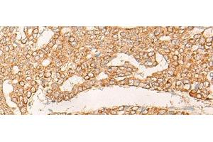 Immunohistochemistry of paraffin-embedded Human liver cancer tissue using KRT9 Polyclonal Antibody at dilution of 1:30(x200) (KRT9 anticorps)