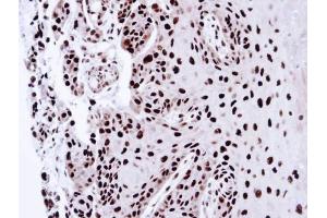 IHC-P Image Immunohistochemical analysis of paraffin-embedded CA922 xenograft, using PSME3, antibody at 1:100 dilution. (PSME3 anticorps)