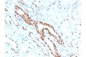 Formalin-fixed, paraffin-embedded human Renal Cell Carcinoma stained with PAX8 Mouse Monoclonal Antibody (PAX8/1491). (PAX8 anticorps  (AA 60-261))
