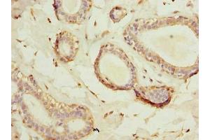 Immunohistochemistry of paraffin-embedded human breast cancer using ABIN7175449 at dilution of 1:100