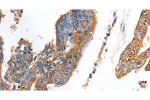 Immunohistochemistry of paraffin-embedded Human colon cancer using AKR1D1 Polyclonal Antibody at dilution of 1:35 (AKR1D1 anticorps)