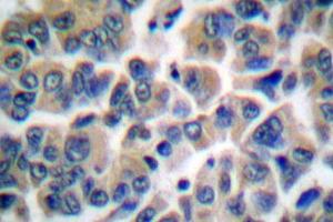 Image no. 2 for anti-Friend Leukemia Virus Integration 1 (FLI1) antibody (ABIN265422) (FLI1 anticorps)