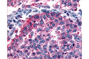Anti-GRM6 / MGLUR6 antibody IHC of human Lung, Non-Small Cell Carcinoma.