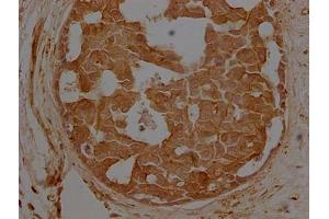 IHC image of ABIN7127368 diluted at 1:500 and staining in paraffin-embedded breast cancer performed on a Leica BondTM system.