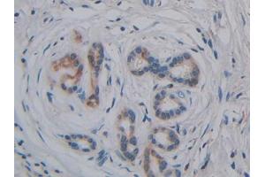 DAB staining on IHC-P;;Samples: Human Pancreatic cancer Tissue (GPLD1 anticorps  (AA 496-840))