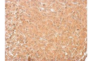 IHC-P Image GAD65 antibody detects GAD2 protein at cytosol on RT2 xenograft by immunohistochemical analysis.