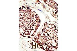 Formalin-fixed and paraffin-embedded human hepatocellular carcinoma tissue reacted with ERBB3 polyclonal antibody  , which was peroxidase-conjugated to the secondary antibody, followed by DAB staining.