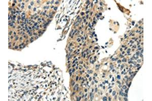 The image on the left is immunohistochemistry of paraffin-embedded Human esophagus cancer tissue using ABIN7190243(CHGB Antibody) at dilution 1/30, on the right is treated with synthetic peptide.