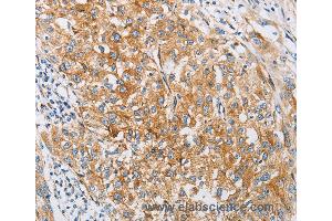Immunohistochemistry of Human esophagus cancer using IFITM3 Polyclonal Antibody at dilution of 1:25 (IFITM3 anticorps)