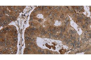 Immunohistochemistry of paraffin-embedded Human colon cancer tissue using FOLH1B Polyclonal Antibody at dilution 1:30 (FOLH1B anticorps)