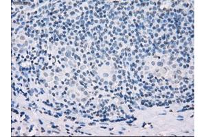 Immunohistochemical staining of paraffin-embedded Adenocarcinoma of colon tissue using anti-SSX2mouse monoclonal antibody. (SSX2 anticorps)