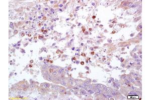 Formalin-fixed and paraffin embedded human lung carcinoma labeled with Anti Integrin Alpha X/CD11c Polyclonal Antibody, Unconjugated (ABIN741285) at 1:200 followed by conjugation to the secondary antibody and DAB staining.