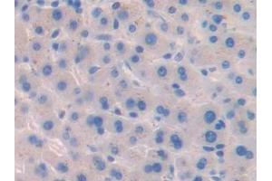Detection of BCHE in Human Liver cancer Tissue using Polyclonal Antibody to Butyrylcholinesterase (BCHE)