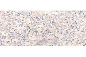 Immunohistochemistry of paraffin-embedded Human cervical cancer tissue using IL26 Polyclonal Antibody at dilution of 1:30(x200) (IL-26 anticorps)
