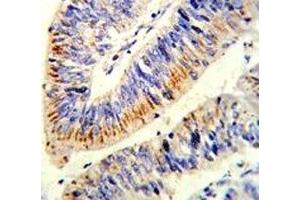 IHC analysis of FFPE human colon carcinoma stained with p65 antibody