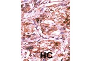 Formalin-fixed and paraffin-embedded human hepatocellular carcinoma tissue reacted with CDC25A (phospho S293) polyclonal antibody  which was peroxidase-conjugated to the secondary antibody followed by AEC staining. (CDC25A anticorps  (pSer293))