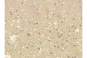 ABIN6257849 and ABIN6275297 at 1/100 staining human glioblastoma by IHC-P. (NXPH3 anticorps  (Internal Region))
