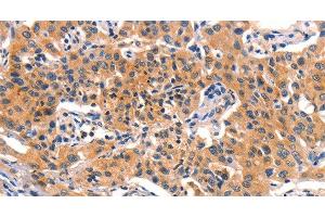 Immunohistochemistry of paraffin-embedded Human lung cancer using AMY2A Polyclonal Antibody at dilution of 1:50 (AMY2A anticorps)