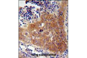 FBXW8 Antibody immunohistochemistry analysis in formalin fixed and paraffin embedded human lung carcinoma followed by peroxidase conjugation of the secondary antibody and DAB staining. (FBXW8 anticorps  (AA 270-299))