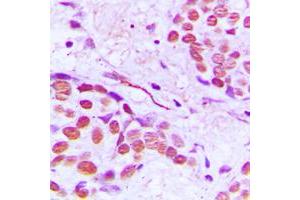 Immunohistochemical analysis of Gamma-tubulin staining in human breast cancer formalin fixed paraffin embedded tissue section.