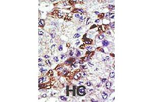 Formalin-fixed and paraffin-embedded human hepatocellular carcinoma tissue reacted with UBE2E3 polyclonal antibody  , which was peroxidase-conjugated to the secondary antibody, followed by AEC staining. (UBE2E3 anticorps  (N-Term))