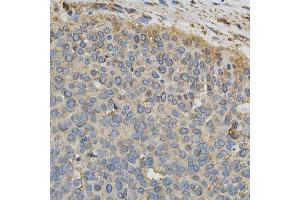 Immunohistochemistry of paraffin-embedded human esophageal cancer using CYP1A1 antibody.